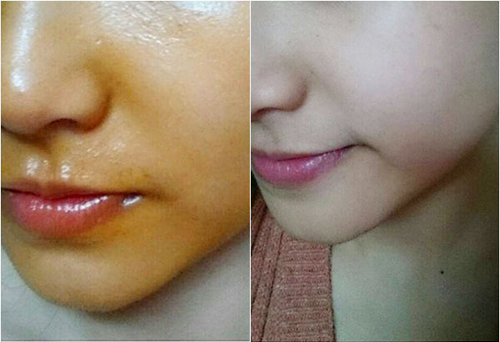 Loại bỏ mụn vết thâm hiệu quả an toàn-5